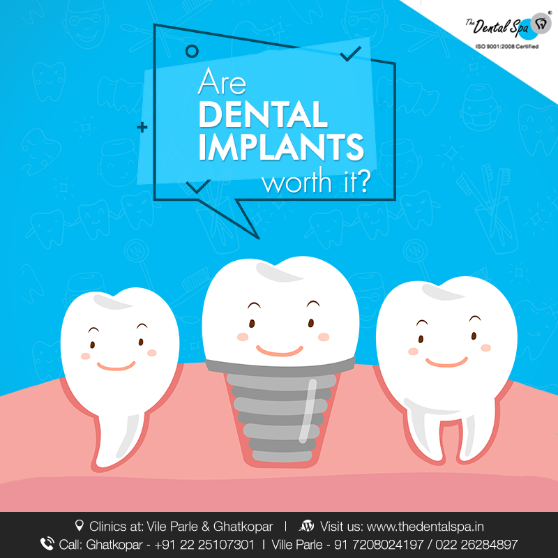 Teeth with Dental Implants